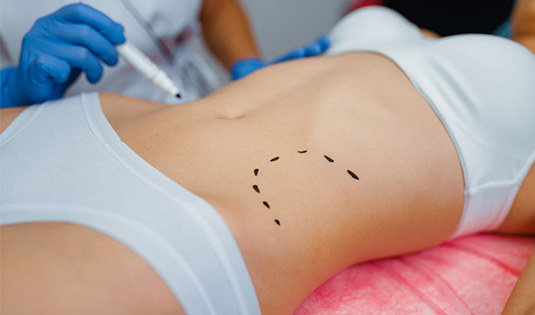 image1 A woman with surgical marks on her abdomen.